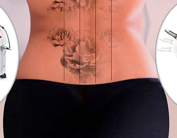 Discover more than 67 stomach tattoo removal best  thtantai2