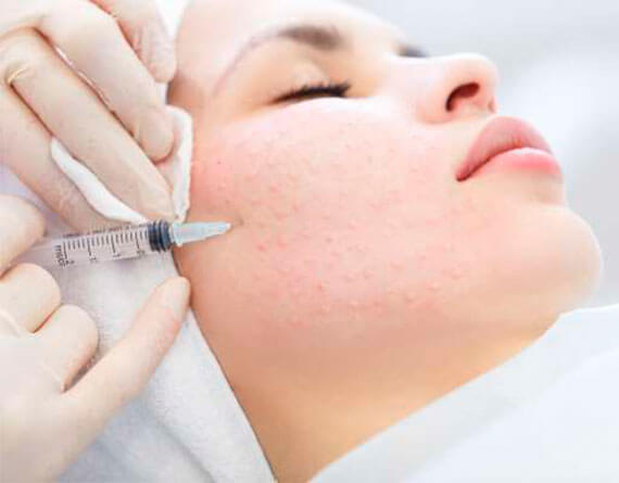 Mesotherapy in Cancun