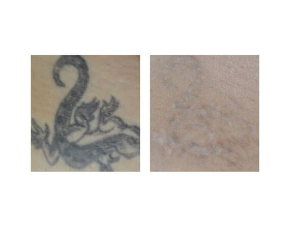 Laser Tattoo Removal in Cancun